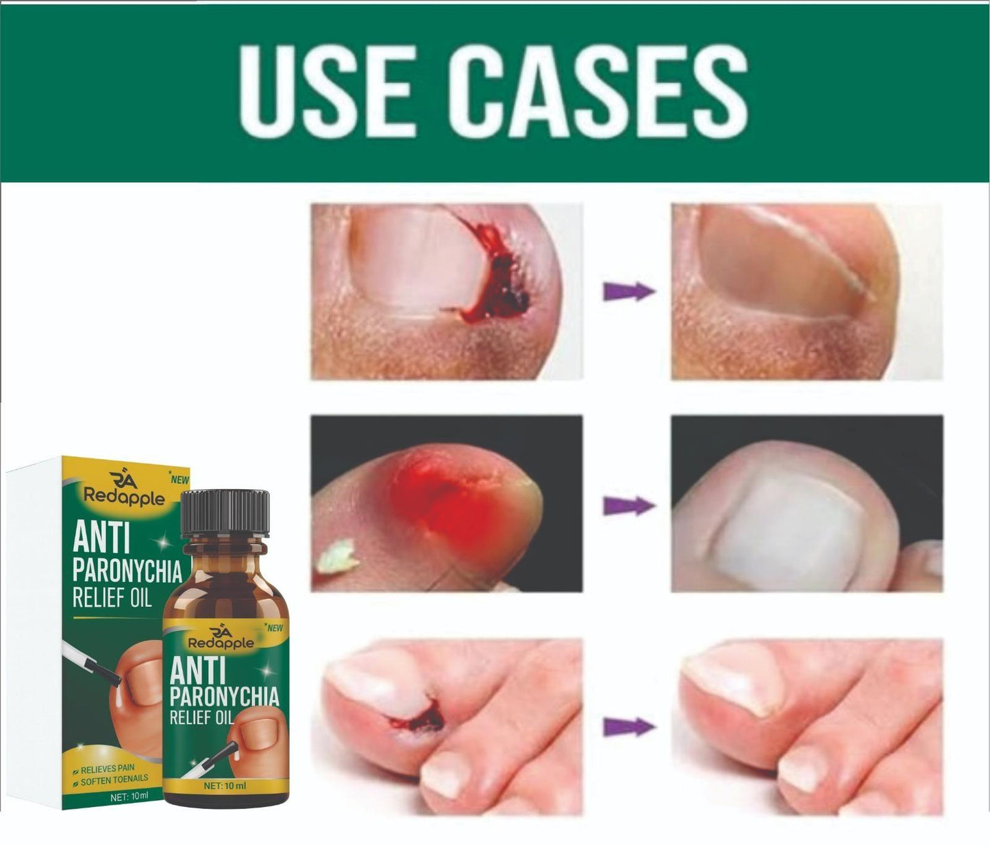 Advertisement for Anti Paronychia Relief Oil showing before and after effects on nails.