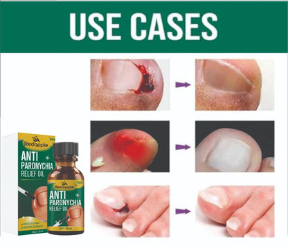 Advertisement for Anti Paronychia Relief Oil showing before and after effects on nails.