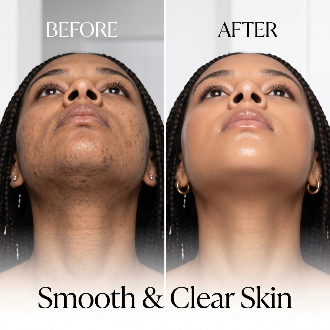Before and after comparison of smooth and clear skin on a person with braided hair.